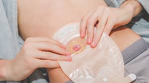 Ostomias